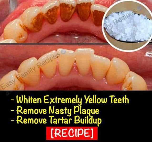 This Can Even Whiten Extremely Yellow Teeth